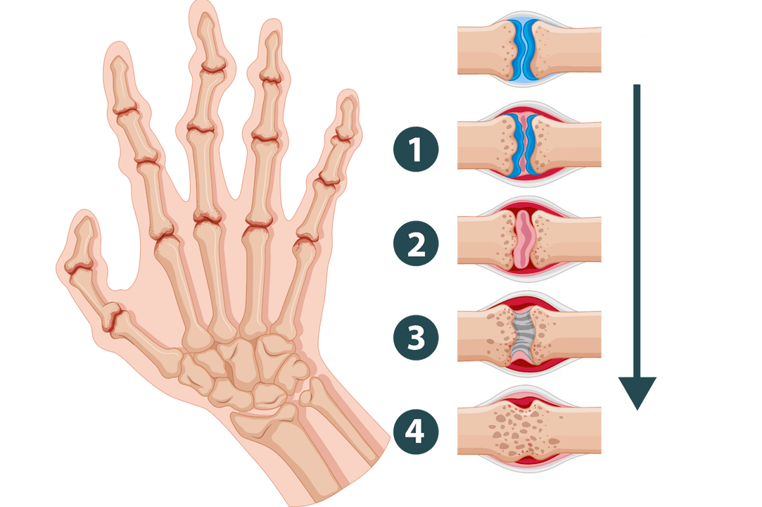 Arthritis development stages - inflammatory joint damage