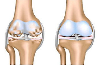 Healthy Articulation and Arthrosis