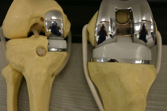 Variants of knee joint endoprophetic