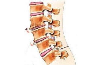 spondylartrosis as causes of back pain
