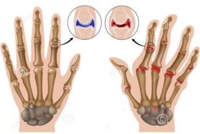 The causes of pain in the fingertips