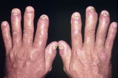 Why the fingertips hurt