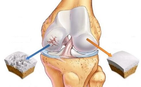 Healthy articulation and knee articulation arthrosis