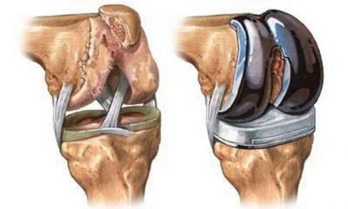 Knee articulation endoprophetic for arthrosis