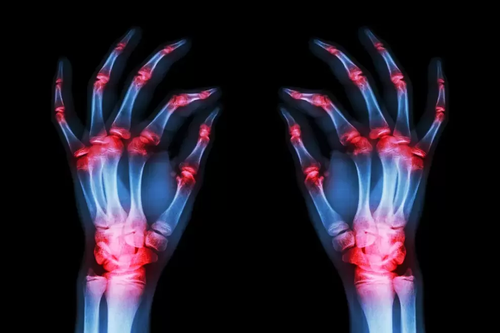 arthrosis of the finger joints